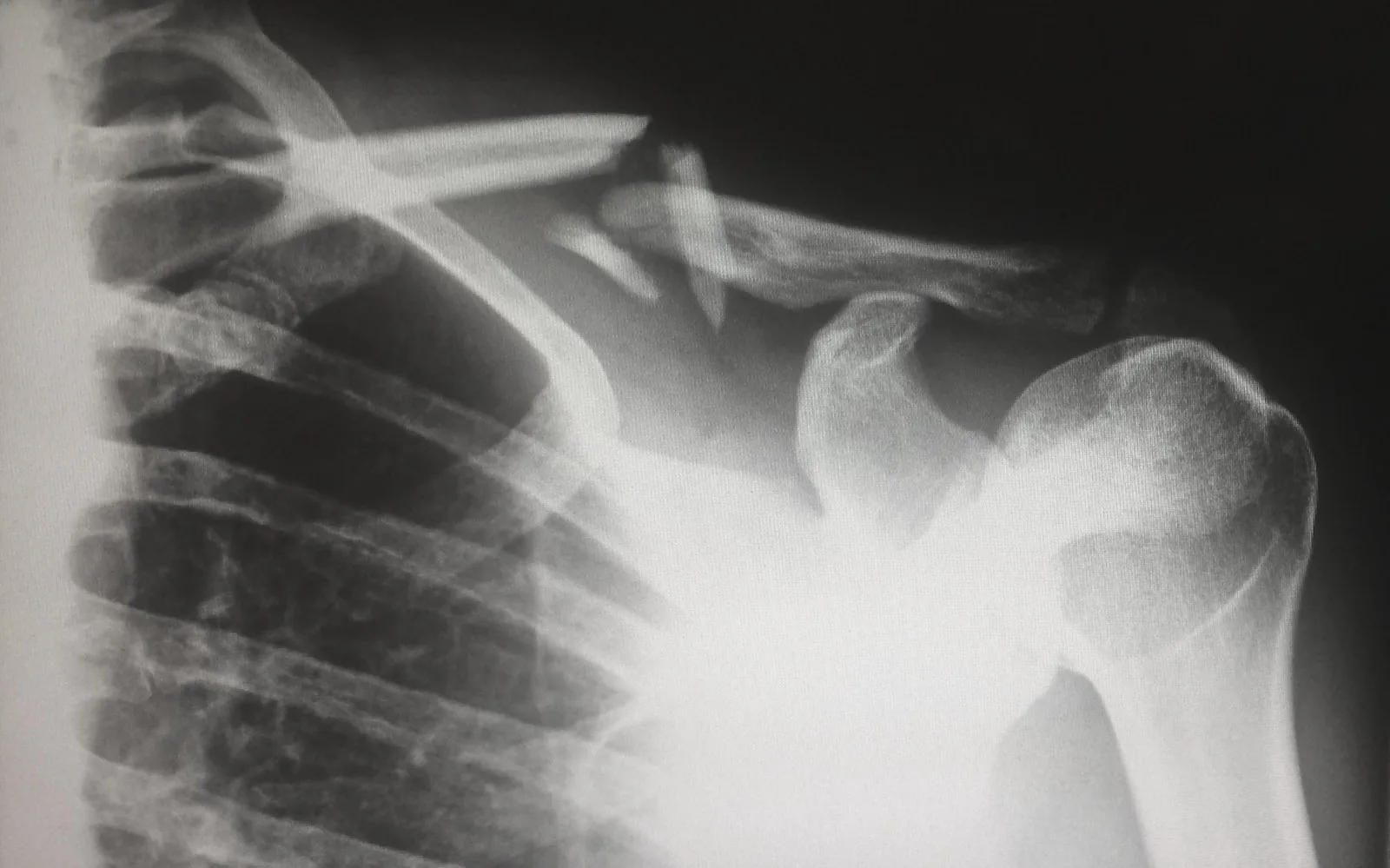 All You Need to Know About a Clavicle Fracture