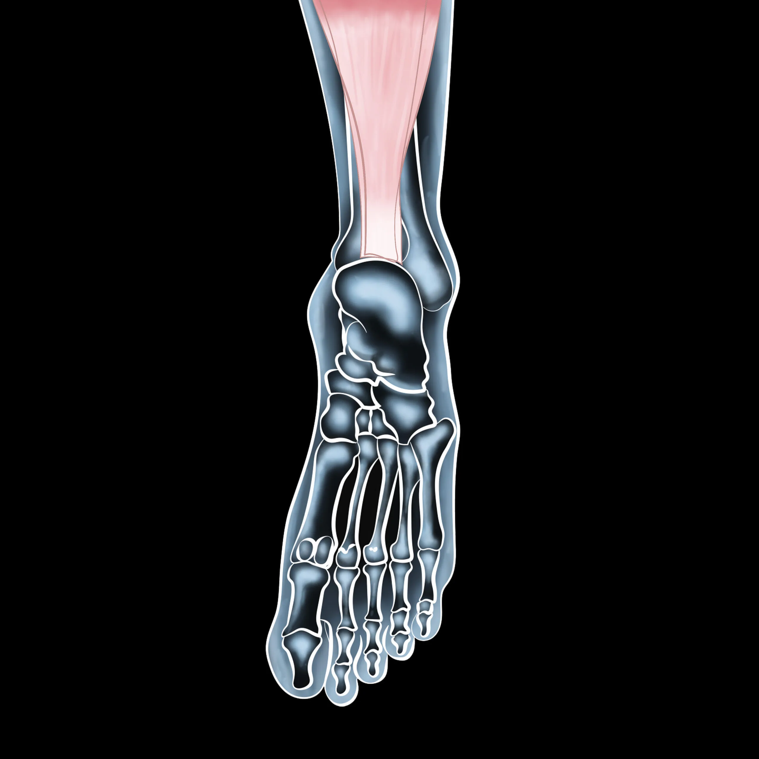 Back on Your Feet: Overcoming Achilles Tendon Injuries with Effective Treatments