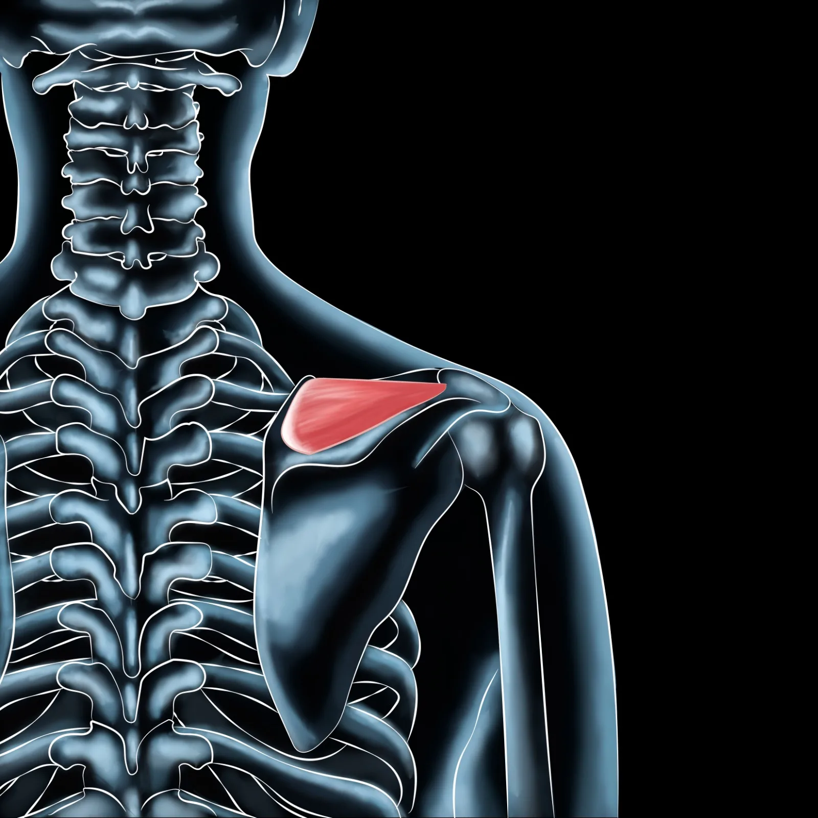 Managing Supraspinatus Muscle Pain for Active Individuals