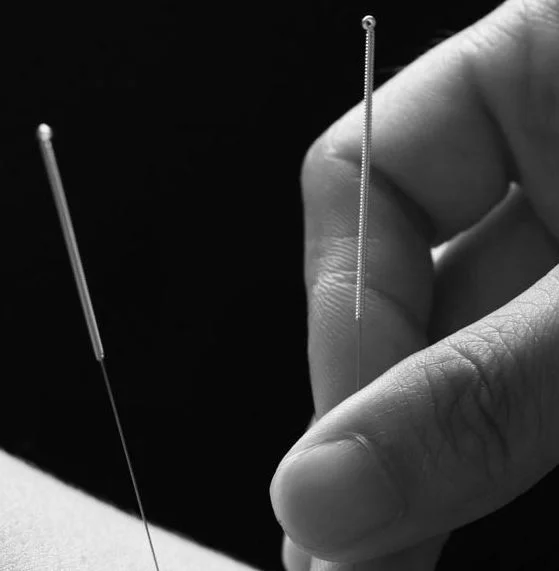Acupuncture