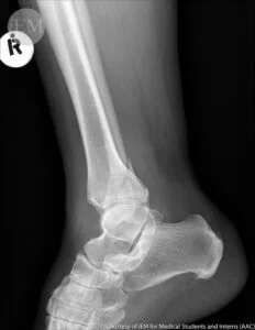 Fibular Stress Fracture