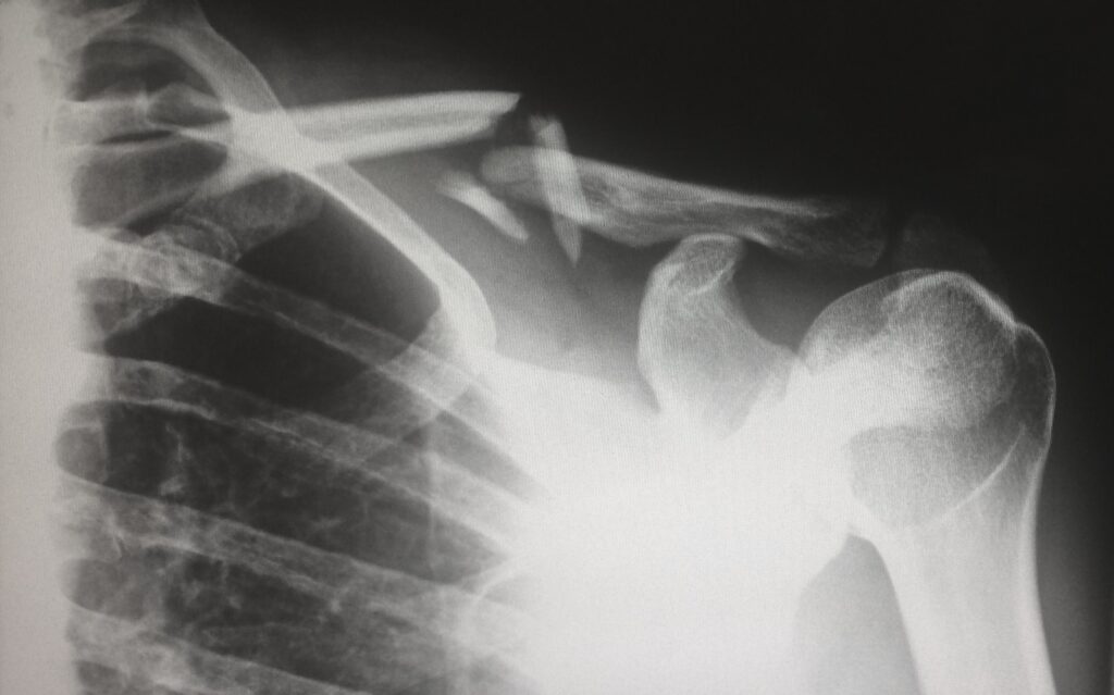 All You Need to Know About a Clavicle Fracture 